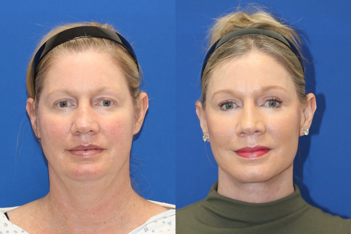 Vertical Restore® / Facial Rejuvenation Before & After Gallery - Patient 252695 - Image 1
