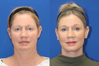 Vertical Restore® / Facial Rejuvenation Before & After Gallery - Patient 252695 - Image 1