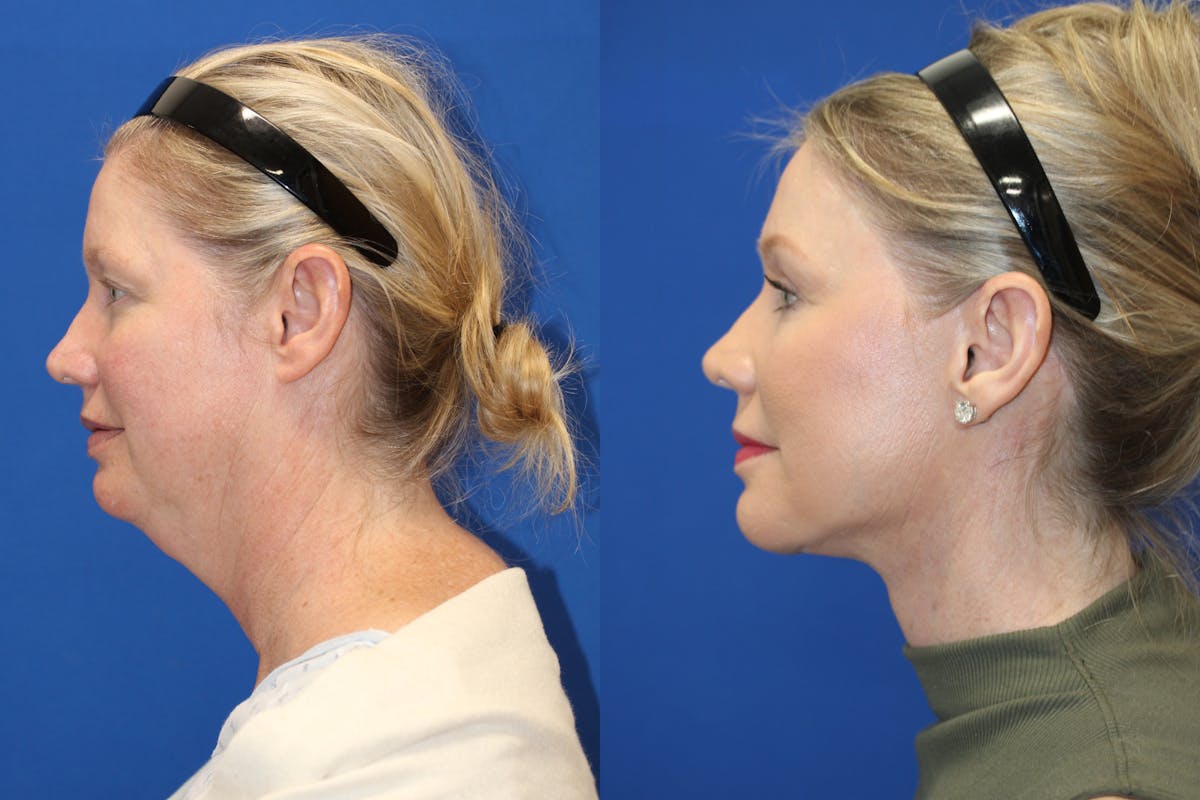 Vertical Restore® / Facial Rejuvenation Before & After Gallery - Patient 252695 - Image 3