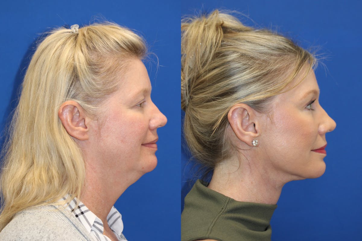 Vertical Restore® / Facial Rejuvenation Before & After Gallery - Patient 252695 - Image 5