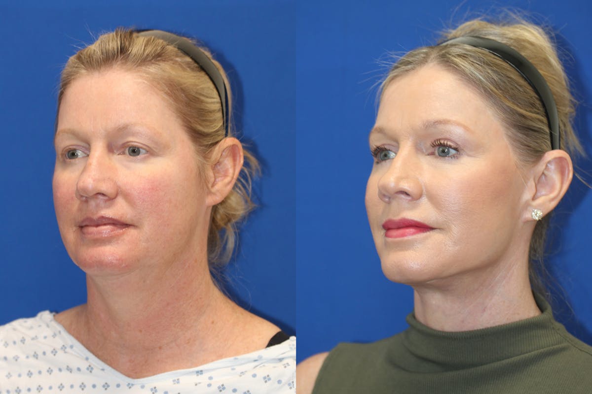 Vertical Restore® / Facial Rejuvenation Before & After Gallery - Patient 252695 - Image 2