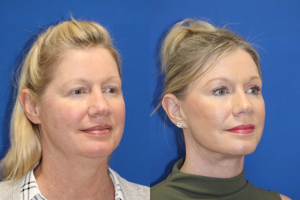 Vertical Restore® / Facial Rejuvenation Before & After Gallery - Patient 252695 - Image 4