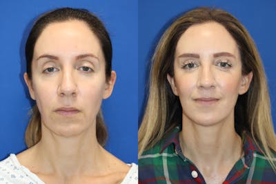 Vertical Restore® / Facial Rejuvenation Before & After Gallery - Patient 263098 - Image 1