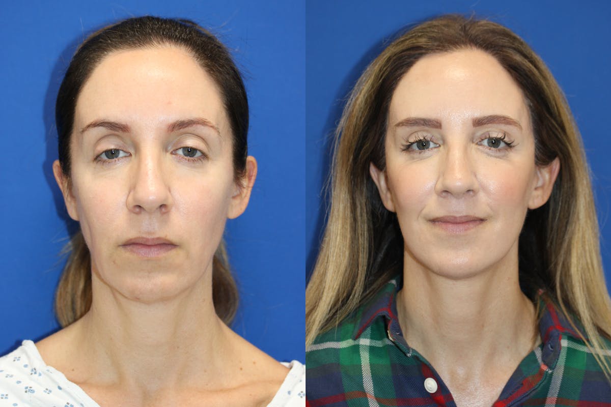 Vertical Restore® / Facial Rejuvenation Before & After Gallery - Patient 263098 - Image 1
