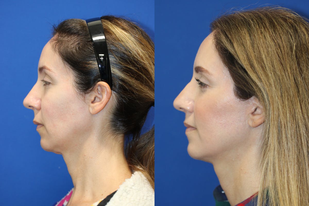 Vertical Restore® / Facial Rejuvenation Before & After Gallery - Patient 263098 - Image 3