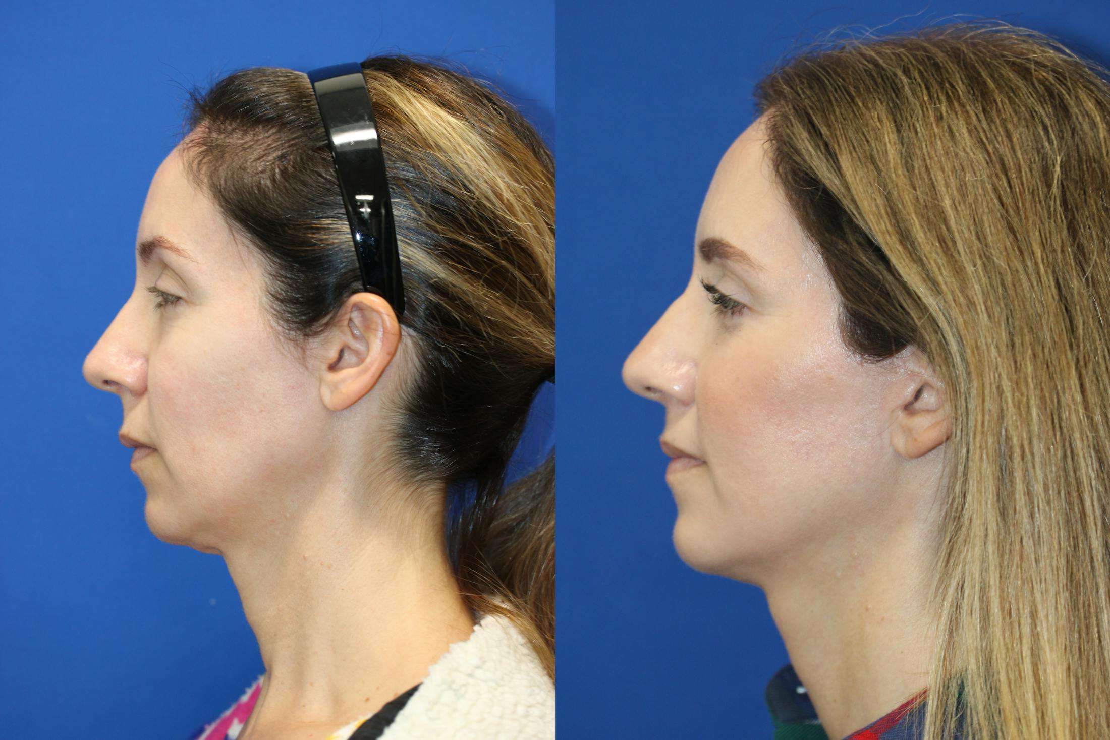 Vertical Restore® / Facial Rejuvenation Before & After Gallery - Patient 263098 - Image 3
