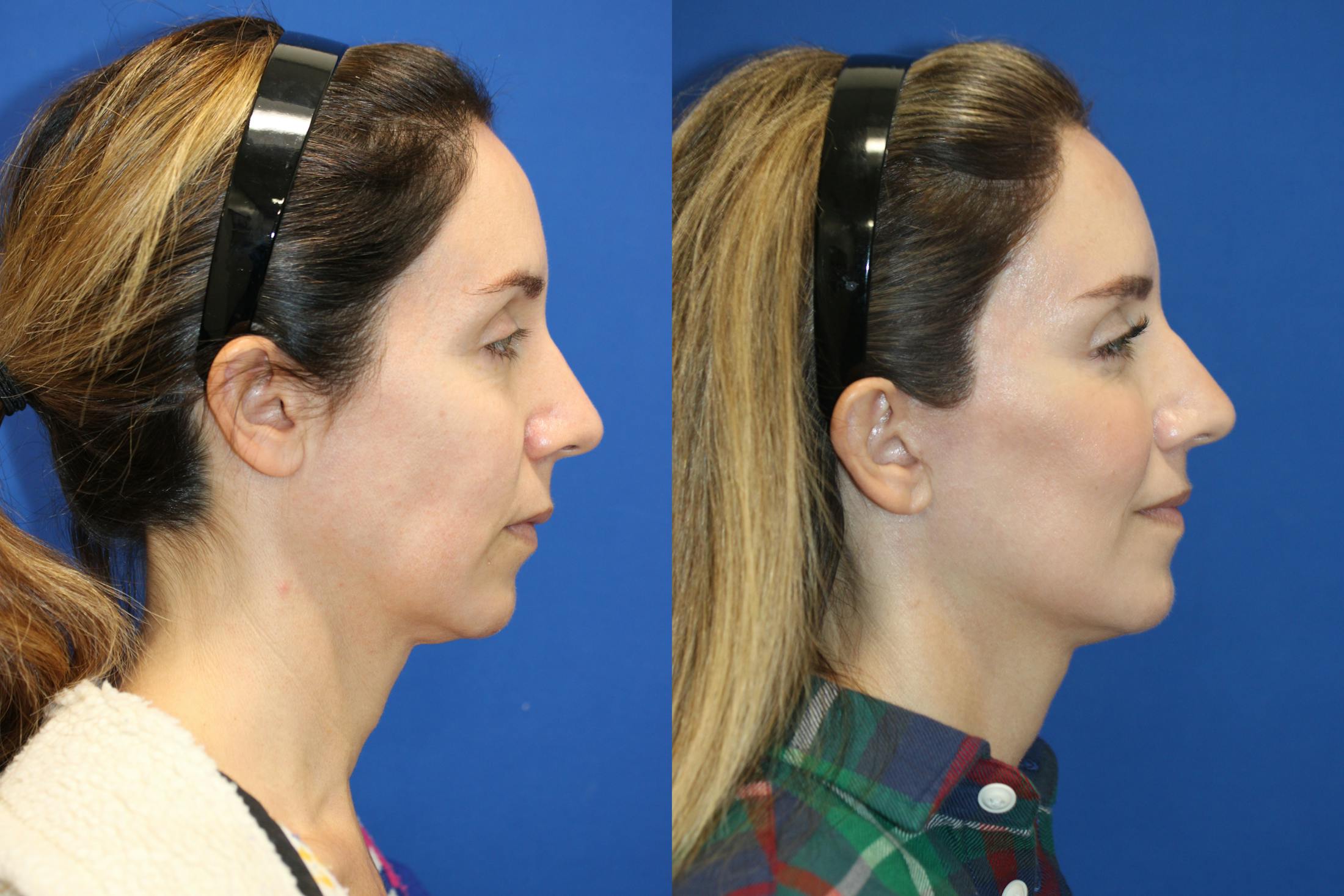 Vertical Restore® / Facial Rejuvenation Before & After Gallery - Patient 263098 - Image 5