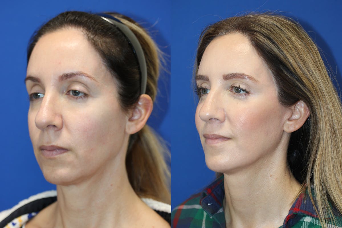Vertical Restore® / Facial Rejuvenation Before & After Gallery - Patient 263098 - Image 2