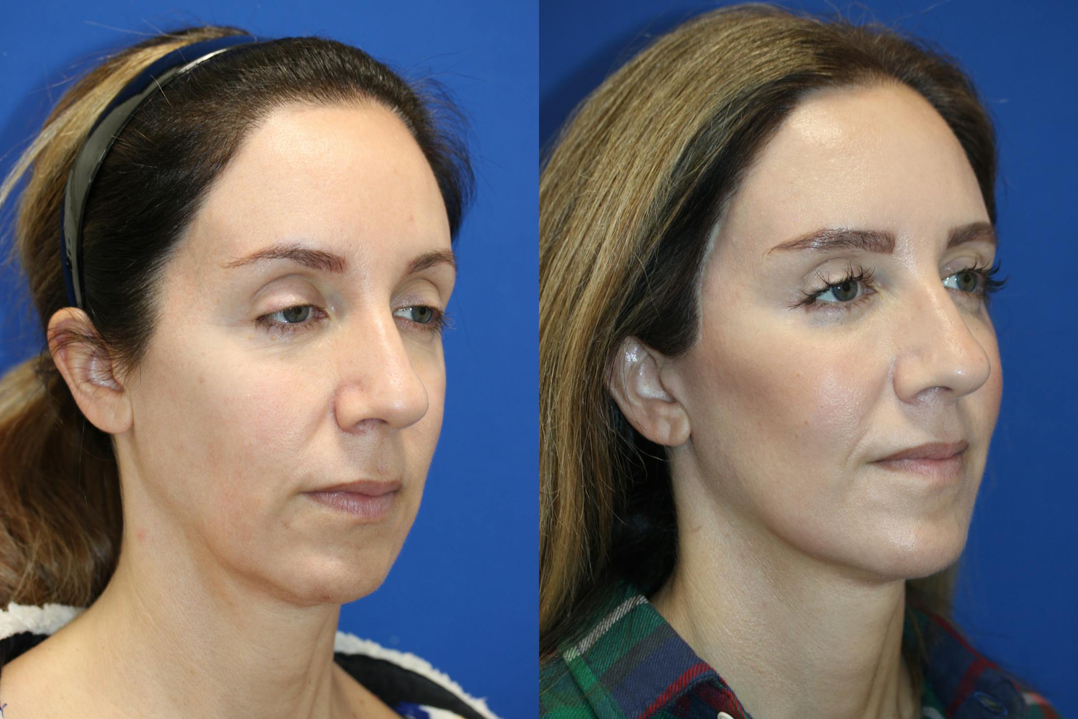 Vertical Restore® / Facial Rejuvenation Before & After Gallery - Patient 263098 - Image 4