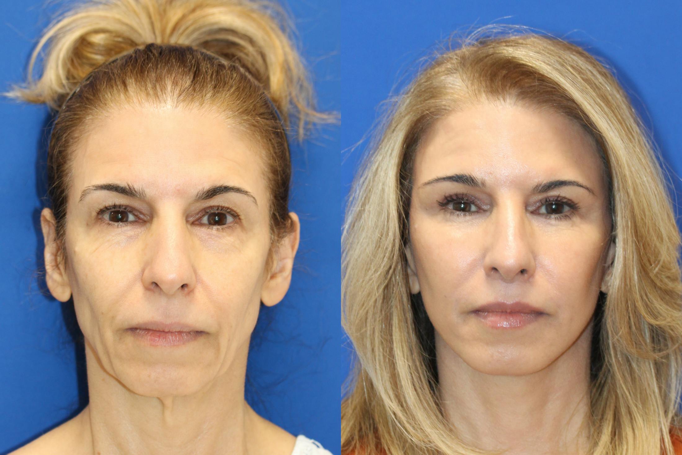 Vertical Restore® / Facial Rejuvenation Before & After Gallery - Patient 312764 - Image 1