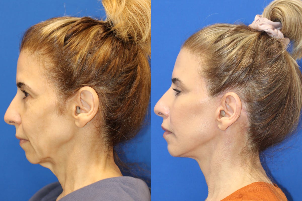 Vertical Restore® / Facial Rejuvenation Before & After Gallery - Patient 312764 - Image 5
