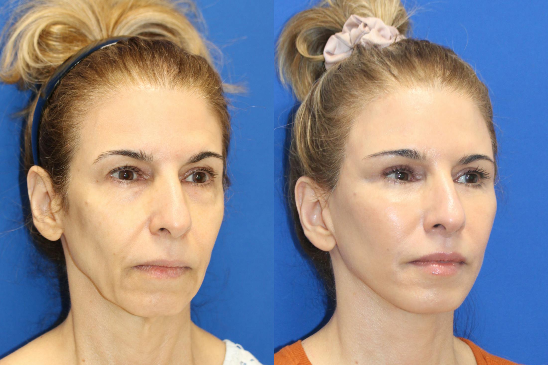 Vertical Restore® / Facial Rejuvenation Before & After Gallery - Patient 312764 - Image 2