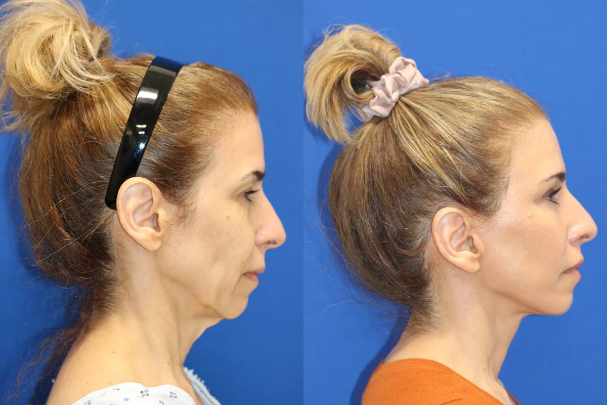 Vertical Restore® / Facial Rejuvenation Before & After Gallery - Patient 312764 - Image 3