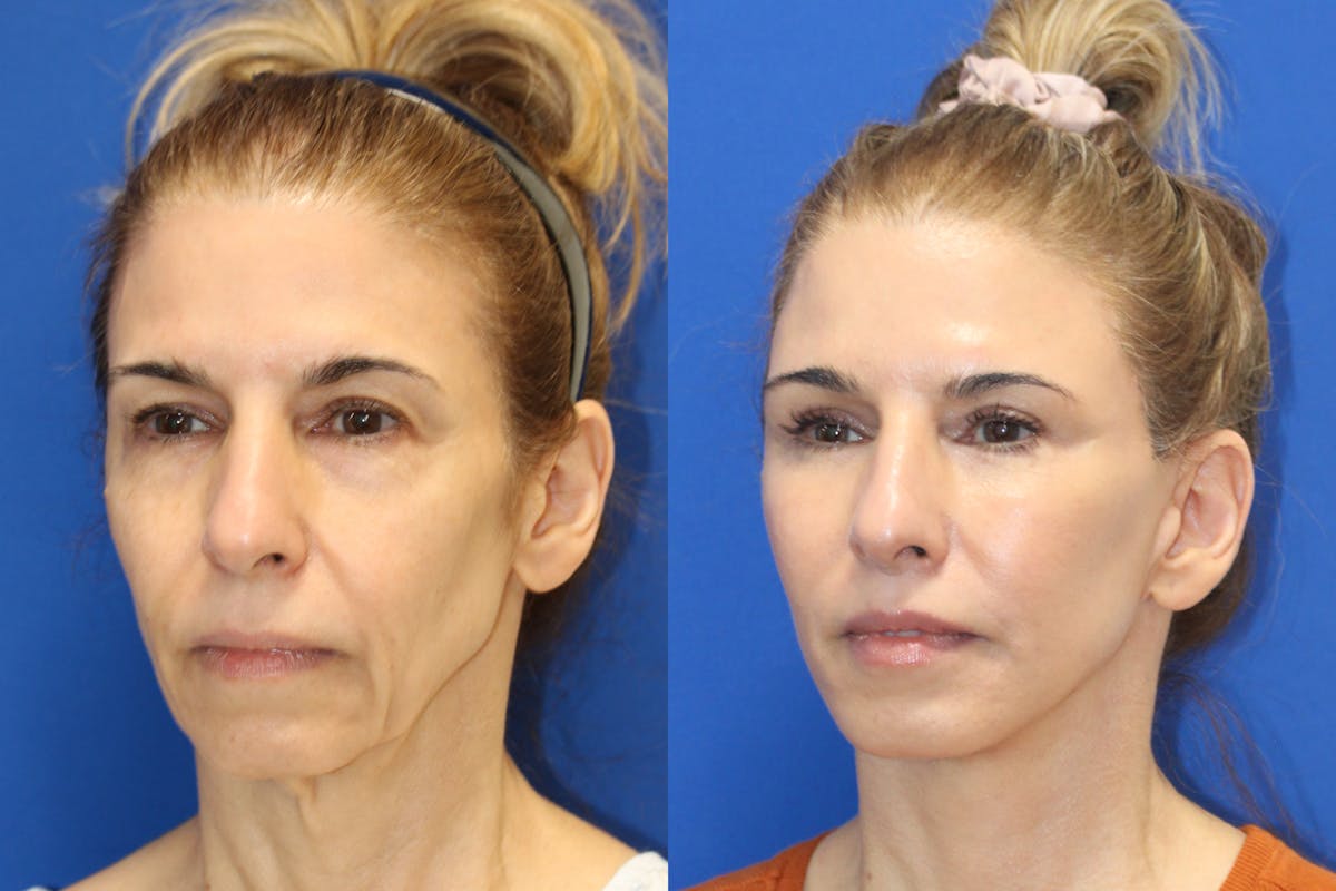 Vertical Restore® / Facial Rejuvenation Before & After Gallery - Patient 312764 - Image 4