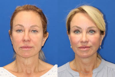 Vertical Restore® / Facial Rejuvenation Before & After Gallery - Patient 243221 - Image 1