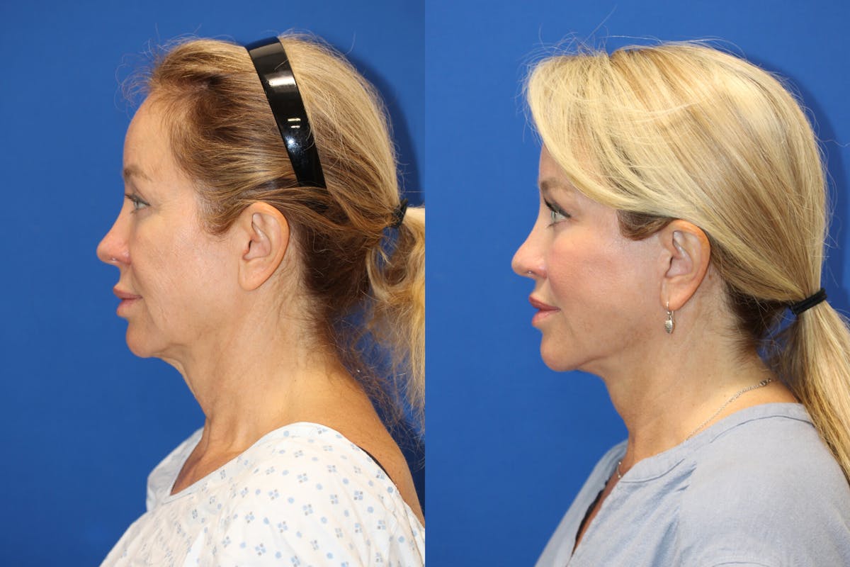 Vertical Restore® / Facial Rejuvenation Before & After Gallery - Patient 243221 - Image 3