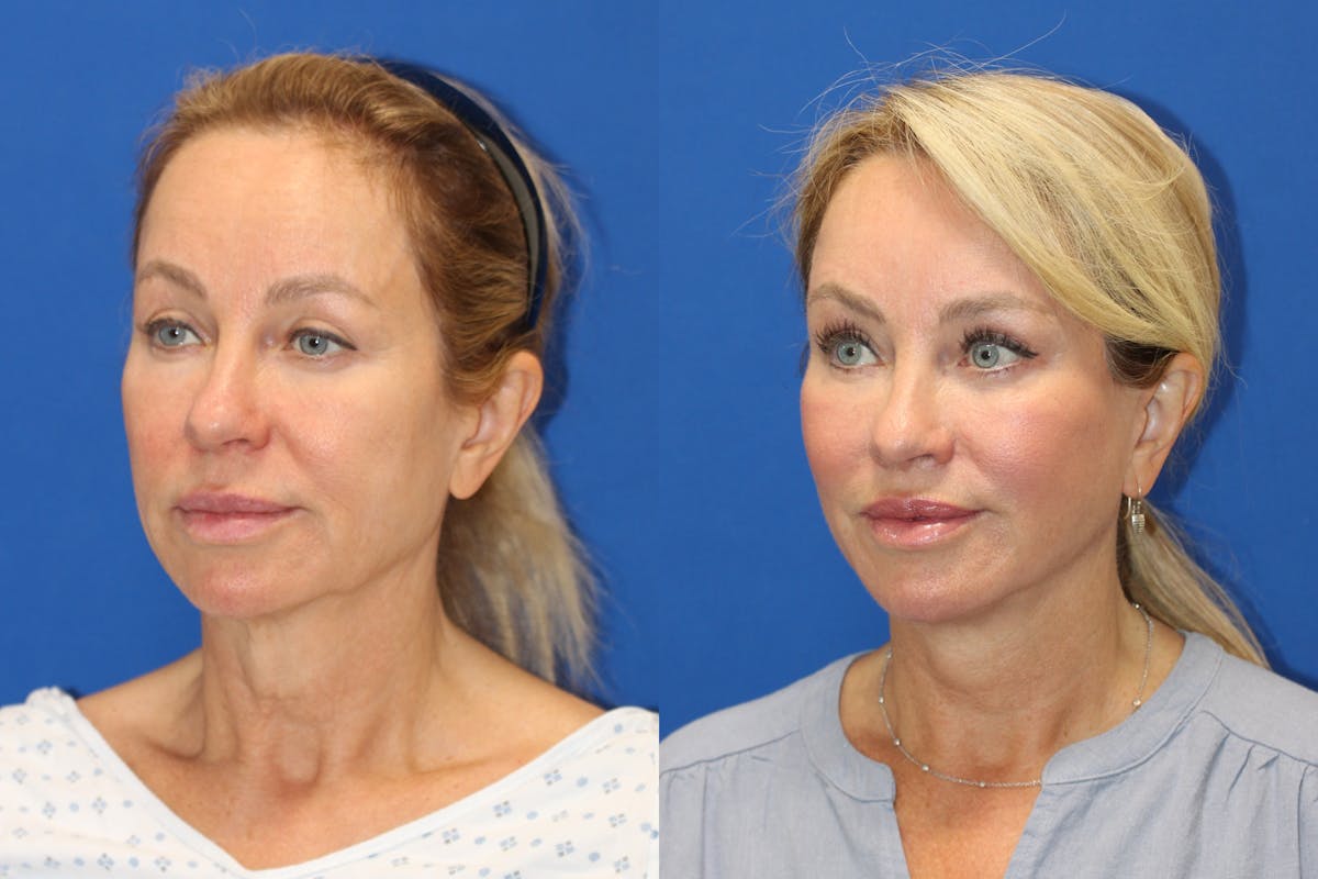 Vertical Restore® / Facial Rejuvenation Before & After Gallery - Patient 243221 - Image 2