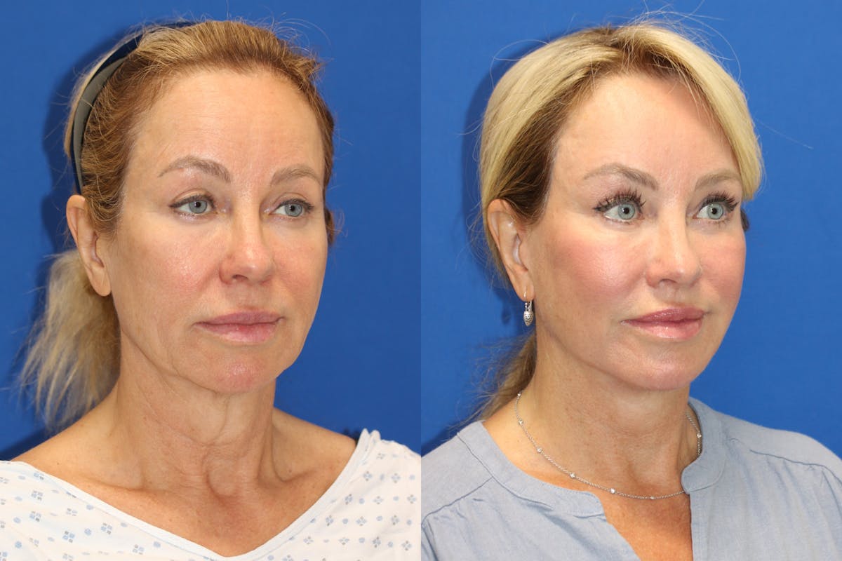 Vertical Restore® / Facial Rejuvenation Before & After Gallery - Patient 243221 - Image 4