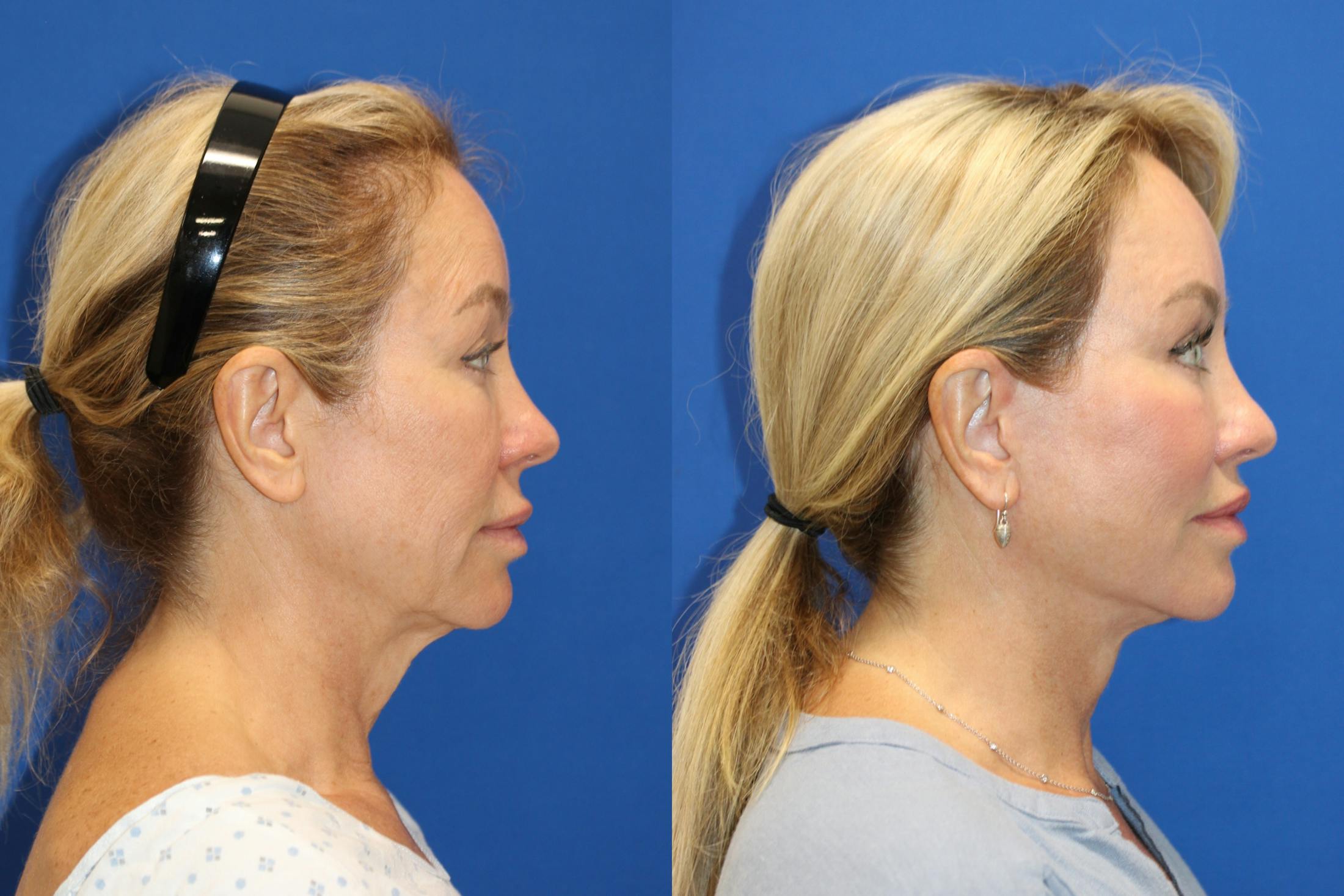 Vertical Restore® / Facial Rejuvenation Before & After Gallery - Patient 243221 - Image 5