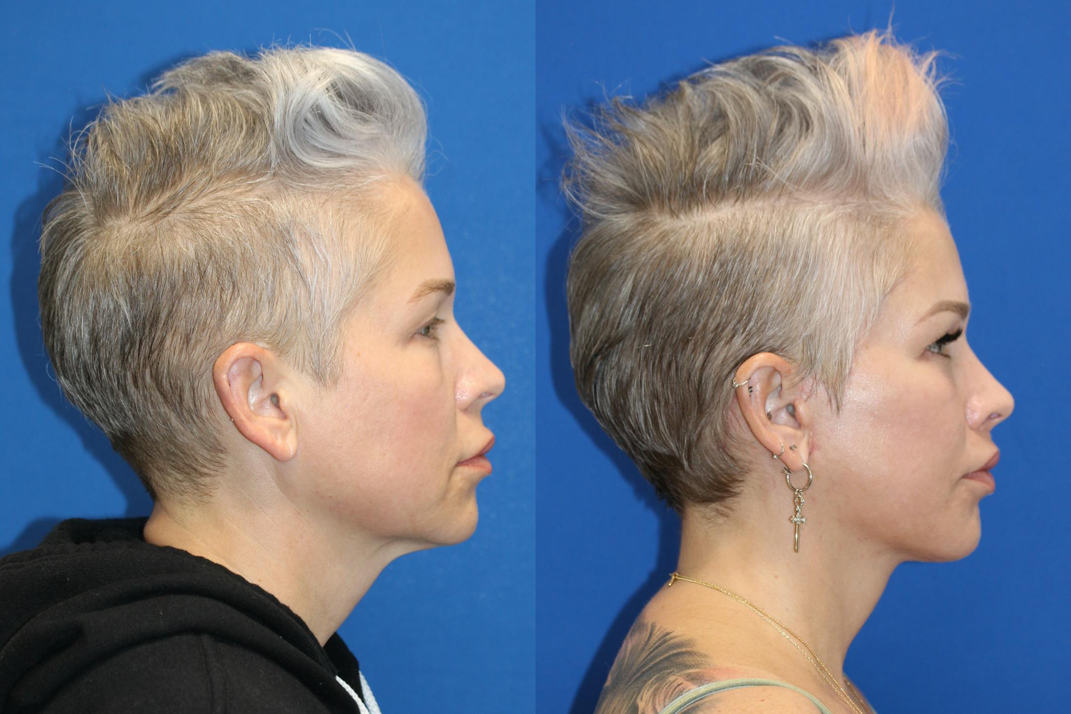Vertical Restore® / Facial Rejuvenation Before & After Gallery - Patient 715077 - Image 2