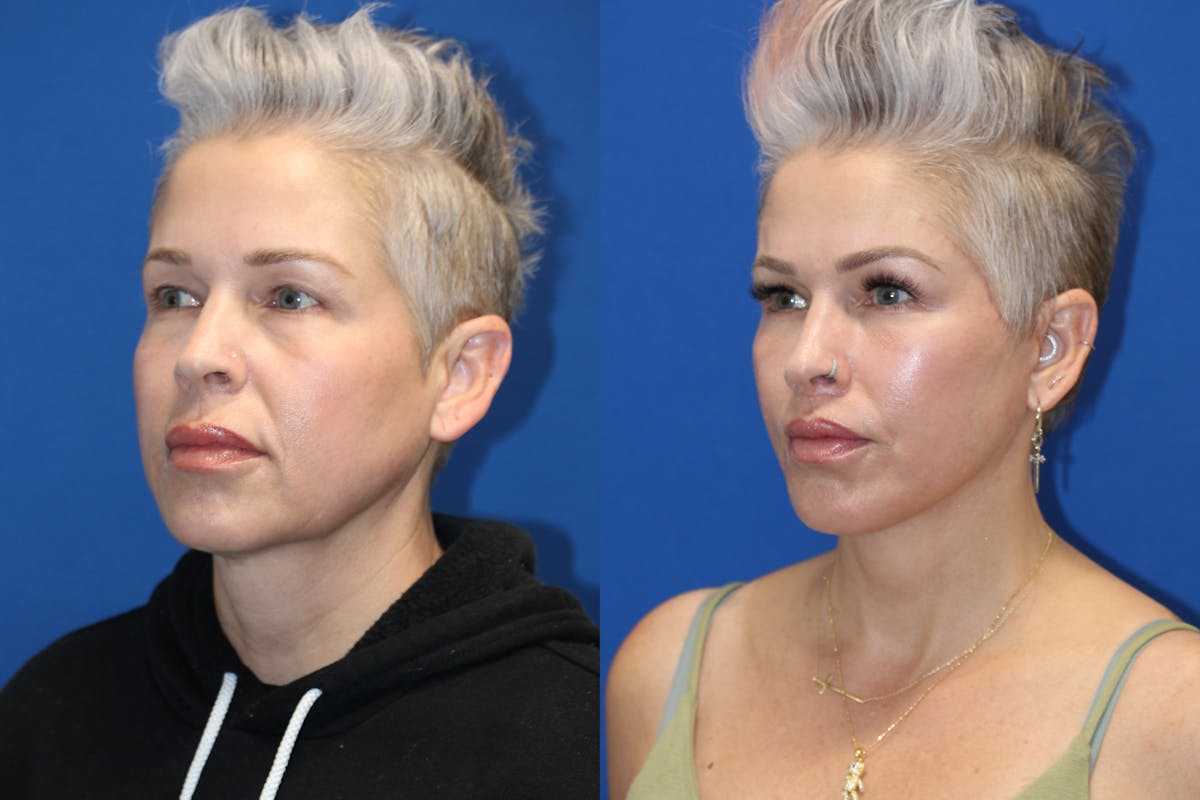 Vertical Restore® / Facial Rejuvenation Before & After Gallery - Patient 715077 - Image 4