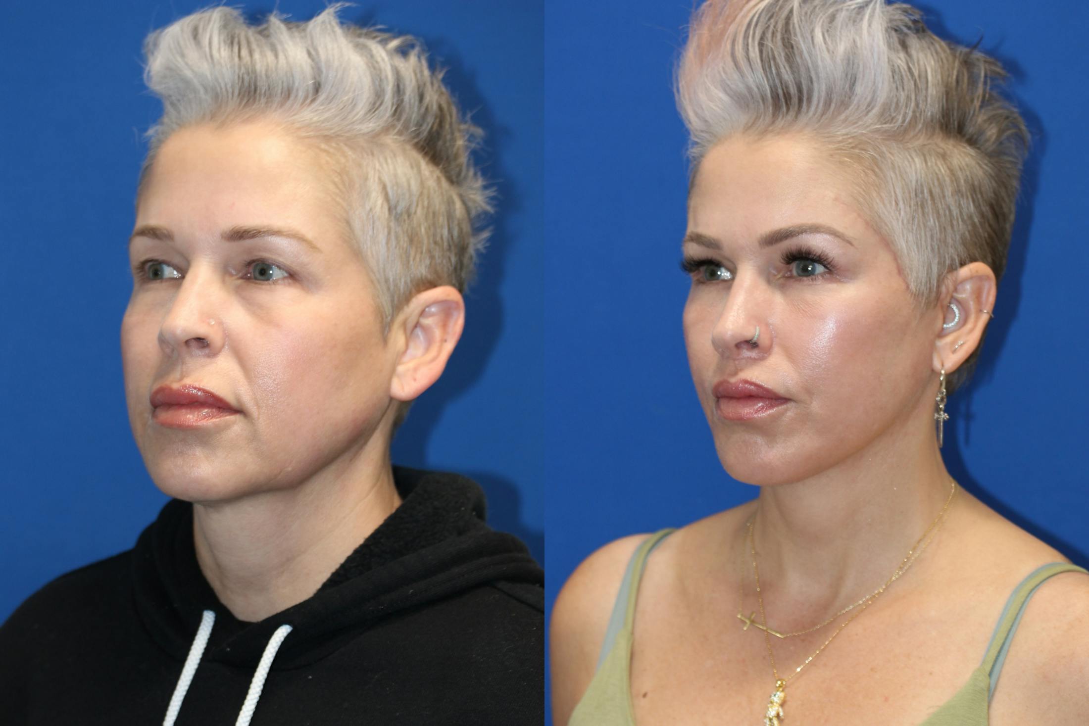 Vertical Restore® / Facial Rejuvenation Before & After Gallery - Patient 715077 - Image 4