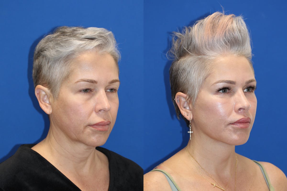 Vertical Restore® / Facial Rejuvenation Before & After Gallery - Patient 715077 - Image 3