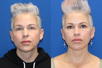 Vertical Restore® / Facial Rejuvenation Before & After Gallery - Patient 715077 - Image 1