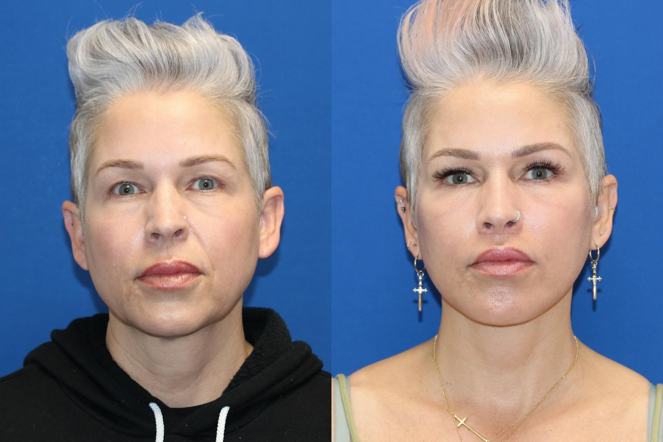 Vertical Restore® / Facial Rejuvenation Before & After Gallery - Patient 715077 - Image 1