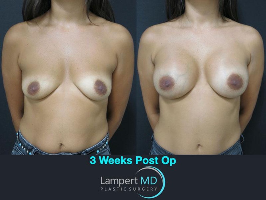 Lampert MD breast augmentation patient 3 weeks post-op