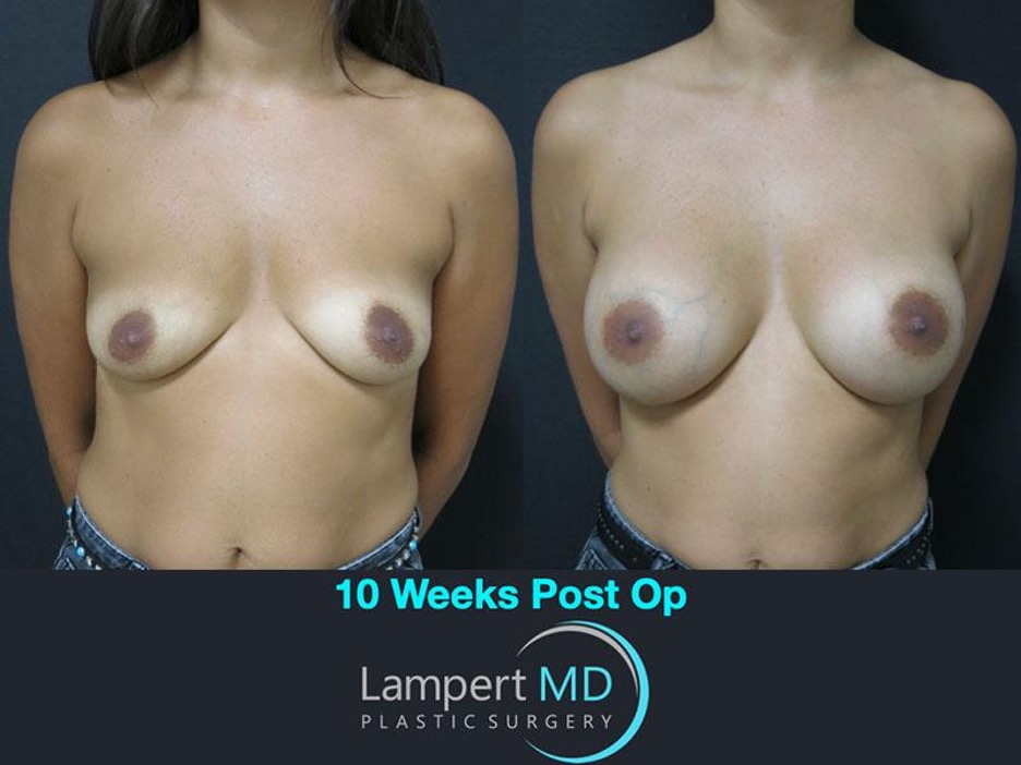 Lampert MD breast augmentation patient 10 weeks post-op