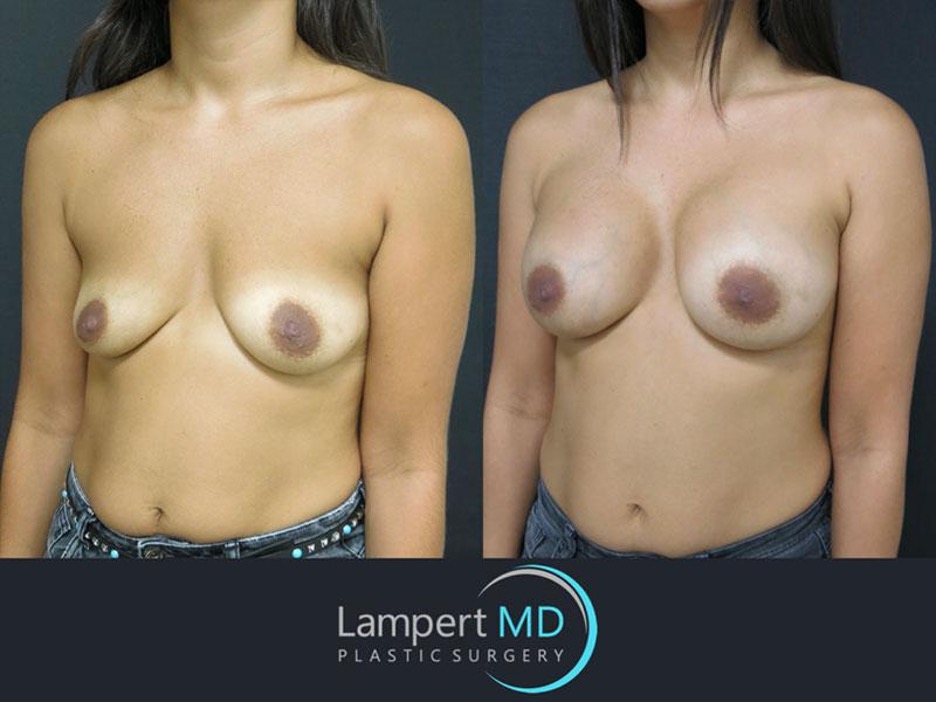 Lampert MD patient before and after breast augmentation