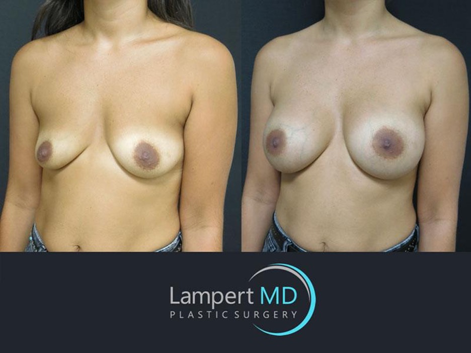 Lampert MD Plastic Surgery patient before and after breast augmentation