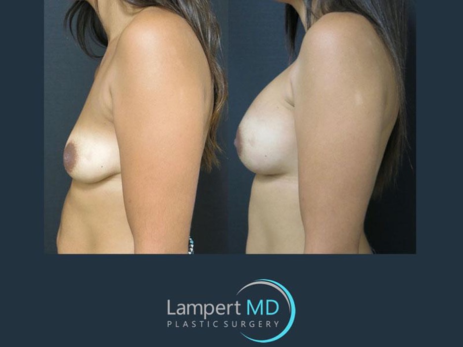 side view of Lampert MD patient before and after breast augmentation