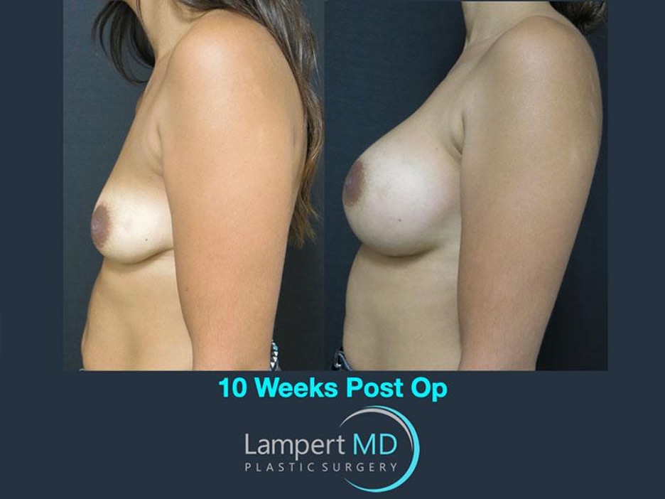 Lampert MD breast augmentation patient 10 weeks post-op