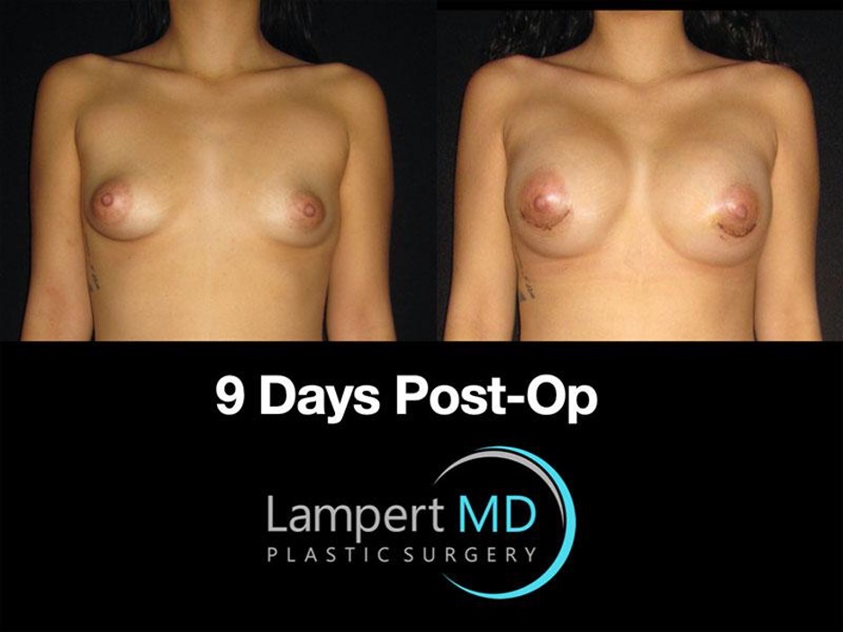 Lampert MD breast augmentation patient 9 days post-op