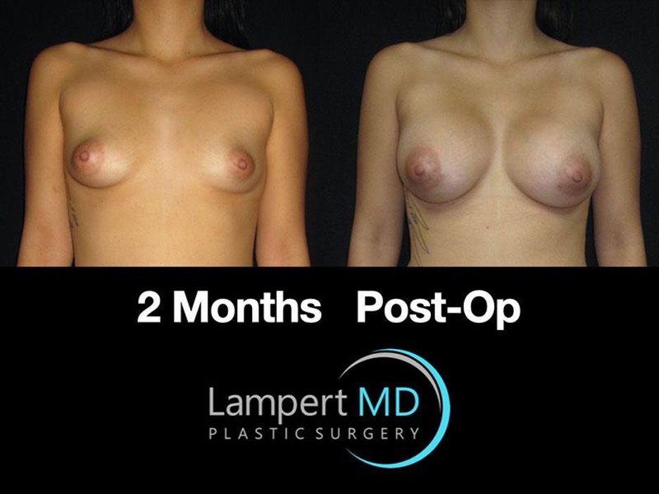 Lampert MD breast augmentation patient 2 months post-op