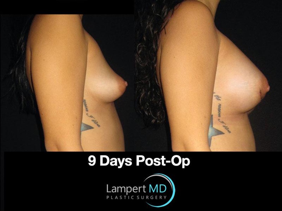 Lampert MD breast augmentation patient 9 days post-op