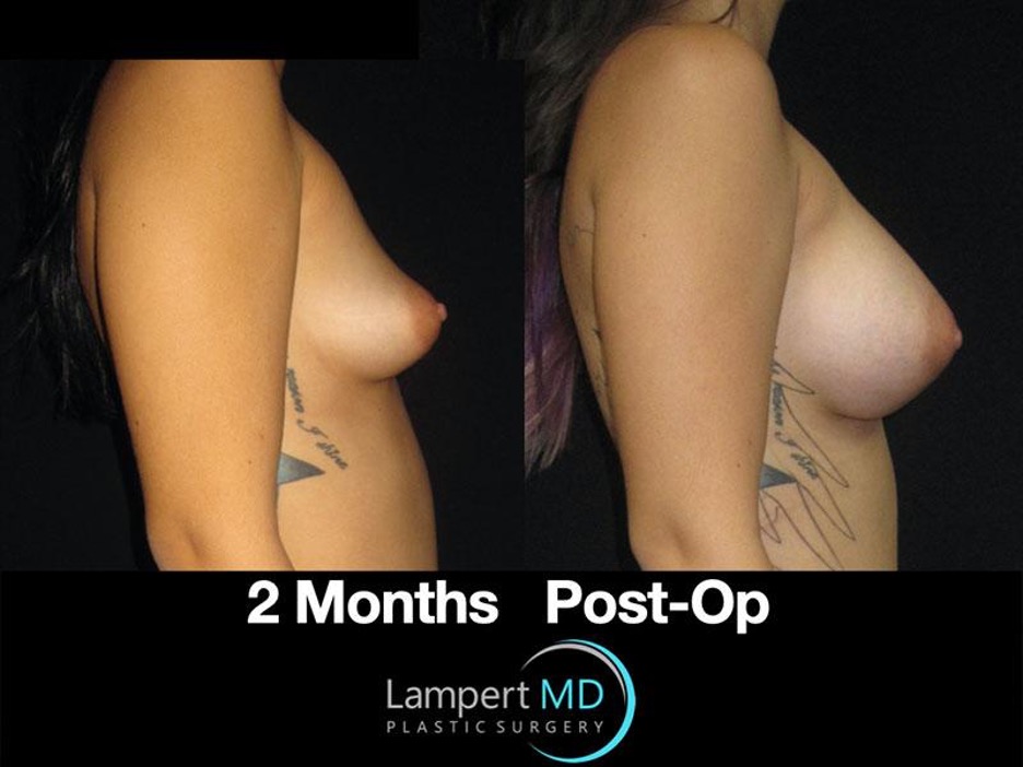 Lampert MD breast augmentation 2 months post-op