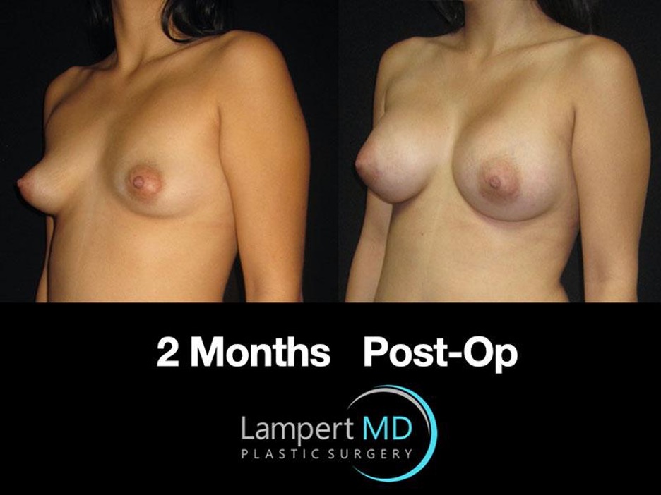 Lampert MD breast augmentation patient 2 months post-op