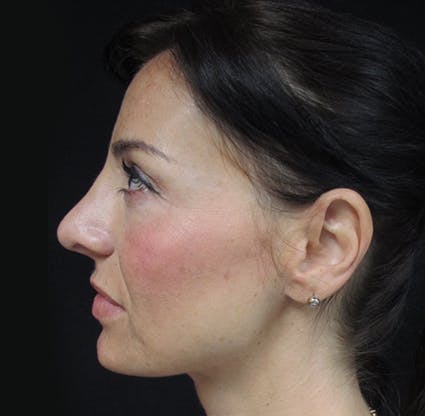 Before and after Rhinoplasty in Miami with Dr. Lampert