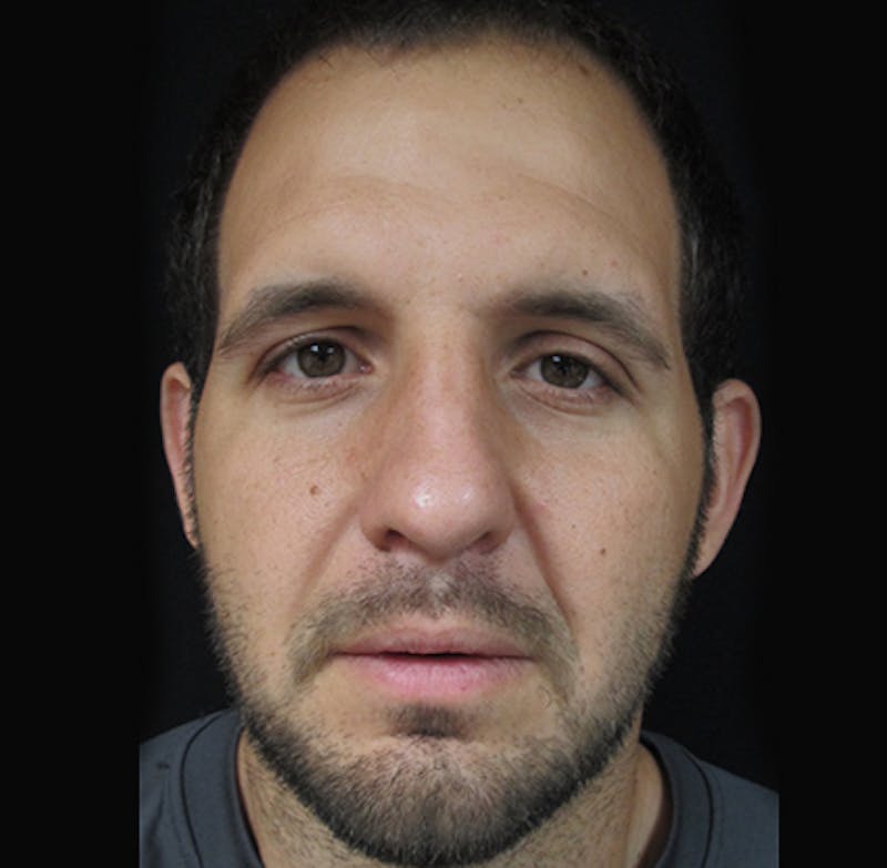 Nasal Fracture Before & After Gallery - Patient 122908648 - Image 2