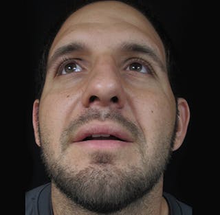 Nasal Fracture Before & After Gallery - Patient 122908648 - Image 12