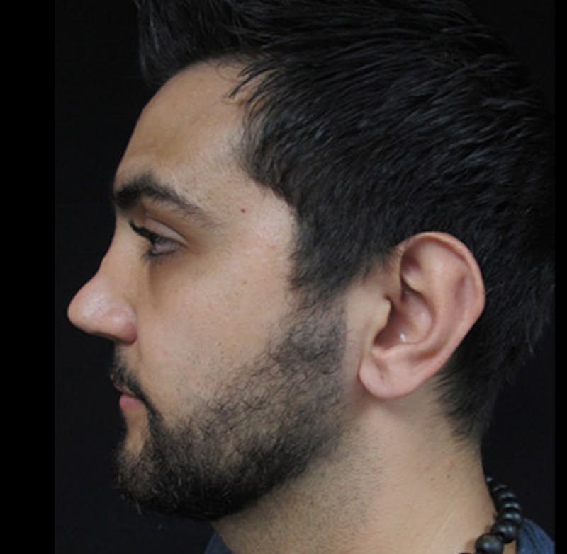 Liquid Rhinoplasty Before & After Gallery - Patient 122908658 - Image 1
