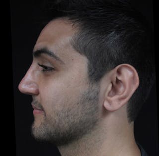 Liquid Rhinoplasty Before & After Gallery - Patient 122908658 - Image 2