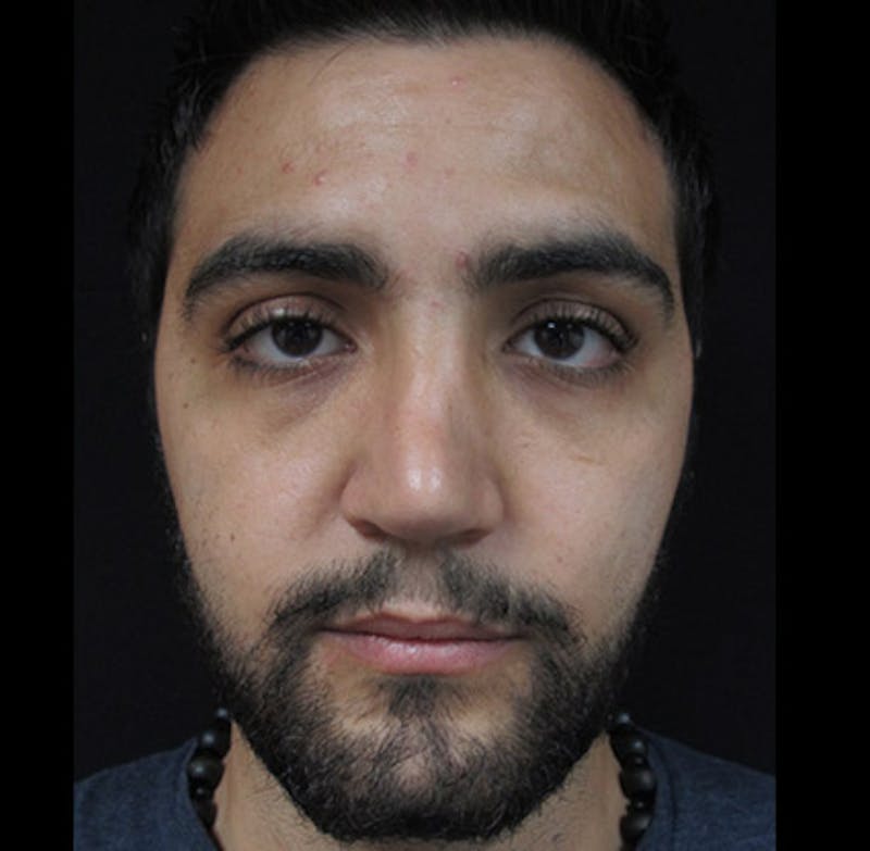 Liquid Rhinoplasty Before & After Gallery - Patient 122908658 - Image 5