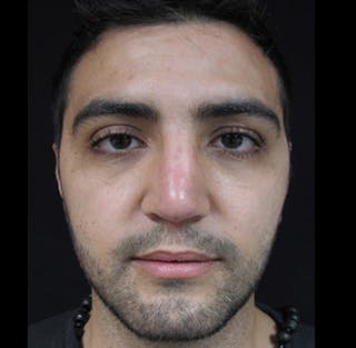 Liquid Rhinoplasty Before & After Gallery - Patient 122908658 - Image 6