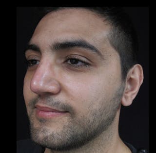 Liquid Rhinoplasty Before & After Gallery - Patient 122908658 - Image 10