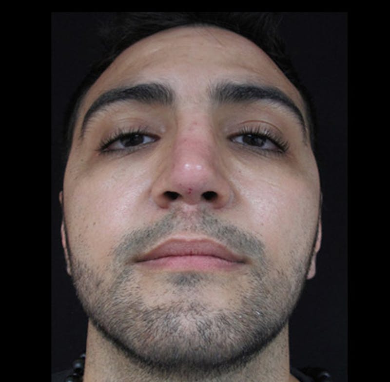 Liquid Rhinoplasty Before & After Gallery - Patient 122908658 - Image 12