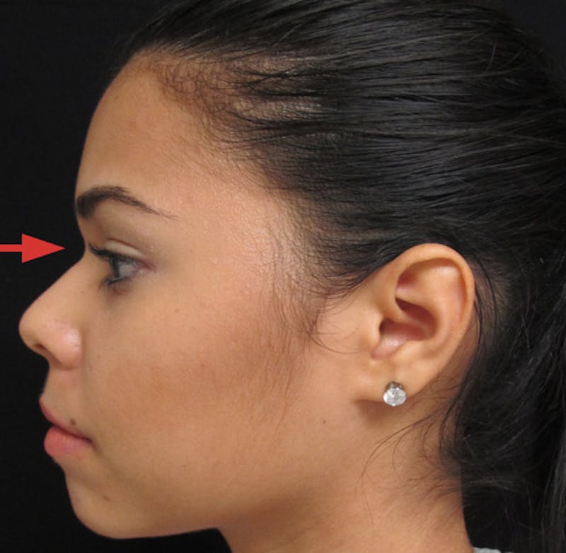 Liquid Rhinoplasty Before & After Gallery - Patient 122908659 - Image 1
